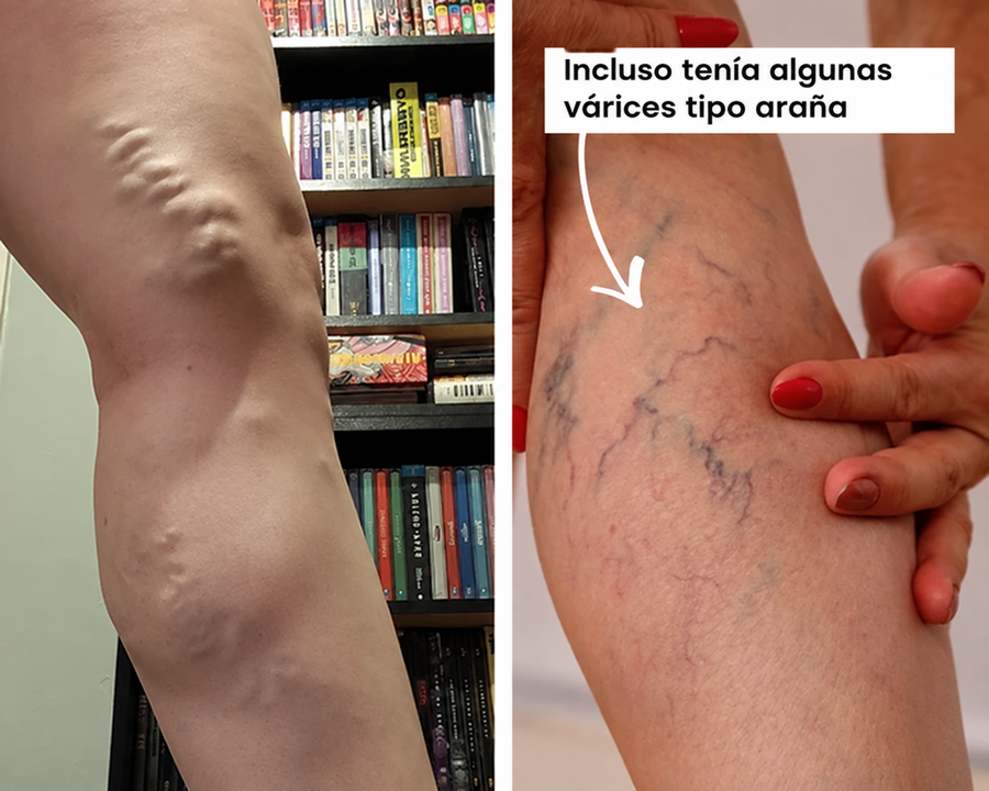 Incluso tenía algunas várices tipo araña